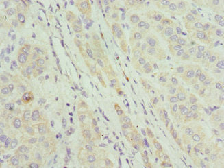 Immunohistochemistry of paraffin-embedded human liver cancer using CSB-PA738750ESR1HU at dilution of 1:100