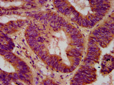 IHC image of CSB-PA740224LA01HU diluted at 1:500 and staining in paraffin-embedded human colon cancer performed on a Leica BondTM system. After dewaxing and hydration, antigen retrieval was mediated by high pressure in a citrate buffer (pH 6.0). S...