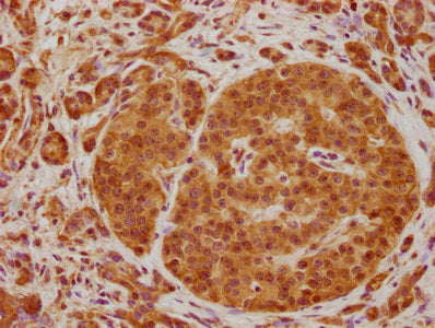 IHC image of CSB-PA740238OA01HU diluted at 1:100 and staining in paraffin-embedded human pancreatic cancer performed on a Leica BondTM system. After dewaxing and hydration, antigen retrieval was mediated by high pressure in a citrate buffer (pH 6....