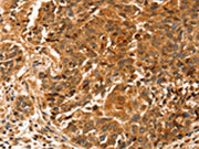 The image on the left is immunohistochemistry of paraffin-embedded Human liver cancer tissue using CSB-PA740658(SLC41A2 Antibody) at dilution 1/20, on the right is treated with synthetic peptide. (Original magnification: ×200)