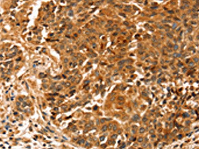 The image on the left is immunohistochemistry of paraffin-embedded Human liver cancer tissue using CSB-PA740658(SLC41A2 Antibody) at dilution 1/20, on the right is treated with synthetic peptide. (Original magnification: ×200)