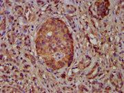IHC image of CSB-PA740713LA01HU diluted at 1:100 and staining in paraffin-embedded human pancreatic cancer performed on a Leica BondTM system. After dewaxing and hydration, antigen retrieval was mediated by high pressure in a citrate buffer (pH 6....