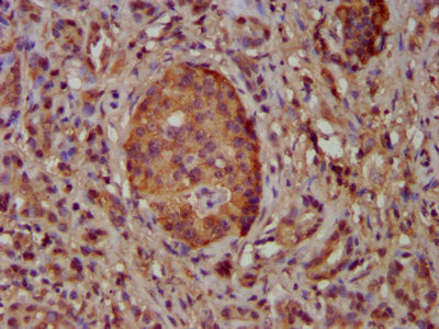 IHC image of CSB-PA740713LA01HU diluted at 1:100 and staining in paraffin-embedded human pancreatic cancer performed on a Leica BondTM system. After dewaxing and hydration, antigen retrieval was mediated by high pressure in a citrate buffer (pH 6....