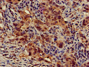 Immunohistochemistry of paraffin-embedded human pancreatic cancer using CSB-PA741052LA01HU at dilution of 1:100