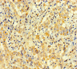 Immunohistochemistry of paraffin-embedded human lung cancer using CSB-PA741070LA01HU at dilution of 1:100