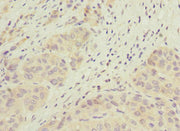 Immunohistochemistry of paraffin-embedded human liver cancer using CSB-PA743563ESR1HU at dilution of 1:100