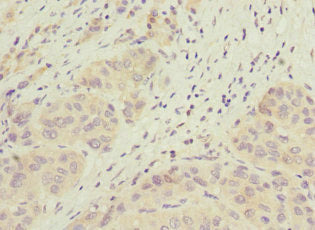 Immunohistochemistry of paraffin-embedded human liver cancer using CSB-PA743563ESR1HU at dilution of 1:100