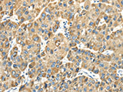 The image on the left is immunohistochemistry of paraffin-embedded Human liver cancer tissue using CSB-PA744019(TMPRSS11E Antibody) at dilution 1/30, on the right is treated with fusion protein. (Original magnification: ×200)