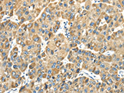 The image on the left is immunohistochemistry of paraffin-embedded Human liver cancer tissue using CSB-PA744019(TMPRSS11E Antibody) at dilution 1/30, on the right is treated with fusion protein. (Original magnification: ×200)