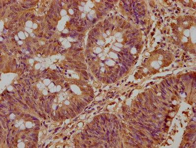 IHC image of CSB-PA744134LA01HU diluted at 1:500 and staining in paraffin-embedded human colon cancer performed on a Leica BondTM system. After dewaxing and hydration, antigen retrieval was mediated by high pressure in a citrate buffer (pH 6.0). S...