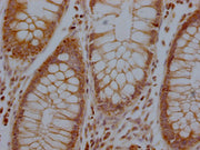 IHC image of CSB-PA744137LA01HU diluted at 1:100 and staining in paraffin-embedded human colon cancer performed on a Leica BondTM system. After dewaxing and hydration, antigen retrieval was mediated by high pressure in a citrate buffer (pH 6.0). S...