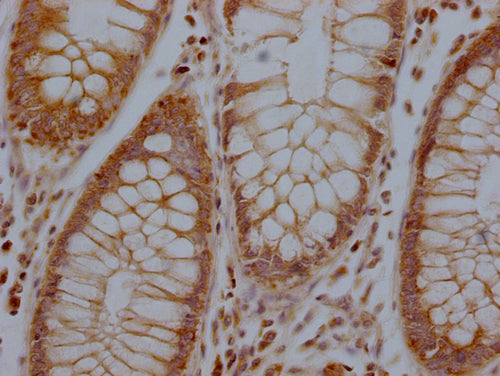 IHC image of CSB-PA744137LA01HU diluted at 1:100 and staining in paraffin-embedded human colon cancer performed on a Leica BondTM system. After dewaxing and hydration, antigen retrieval was mediated by high pressure in a citrate buffer (pH 6.0). S...