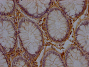 IHC image of CSB-PA744137LA11HU diluted at 1:200 and staining in paraffin-embedded human colon cancer performed on a Leica BondTM system. After dewaxing and hydration, antigen retrieval was mediated by high pressure in a citrate buffer (pH 6.0). S...