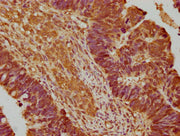IHC image of CSB-PA744265OA01HU diluted at 1:200 and staining in paraffin-embedded human ovarian cancer performed on a Leica BondTM system. After dewaxing and hydration, antigen retrieval was mediated by high pressure in a citrate buffer (pH 6.0)....