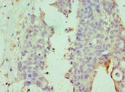 Immunohistochemistry of paraffin-embedded human endometrial cancer using CSB-PA744278ESR1HU at dilution of 1:100