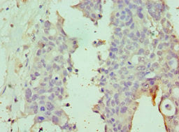 Immunohistochemistry of paraffin-embedded human endometrial cancer using CSB-PA744278ESR1HU at dilution of 1:100