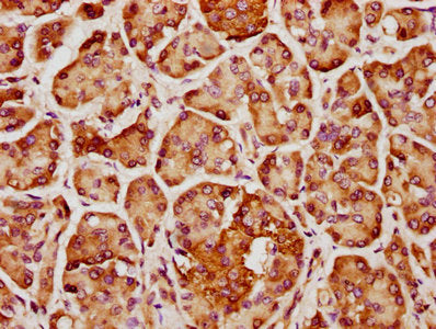 IHC image of CSB-PA744397LA01HU diluted at 1:400 and staining in paraffin-embedded human pancreatic cancer performed on a Leica BondTM system. After dewaxing and hydration, antigen retrieval was mediated by high pressure in a citrate buffer (pH 6....
