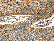 The image on the left is immunohistochemistry of paraffin-embedded Human esophagus cancer tissue using CSB-PA745288(STX19 Antibody) at dilution 1/35, on the right is treated with fusion protein. (Original magnification: ×200)