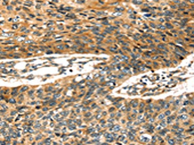 The image on the left is immunohistochemistry of paraffin-embedded Human esophagus cancer tissue using CSB-PA745288(STX19 Antibody) at dilution 1/35, on the right is treated with fusion protein. (Original magnification: ×200)