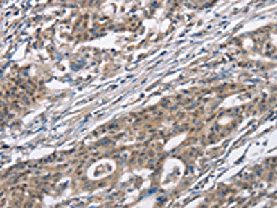The image on the left is immunohistochemistry of paraffin-embedded Human gastic cancer tissue using CSB-PA745307(CACNA1D Antibody) at dilution 1/30, on the right is treated with synthetic peptide. (Original magnification: ×200)