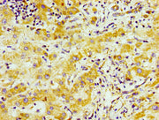 Immunohistochemistry of paraffin-embedded human liver cancer using CSB-PA745330LA01HU at dilution of 1:100