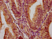 IHC image of CSB-PA745334LA01HU diluted at 1:300 and staining in paraffin-embedded human endometrial cancer performed on a Leica BondTM system. After dewaxing and hydration, antigen retrieval was mediated by high pressure in a citrate buffer (pH 6...