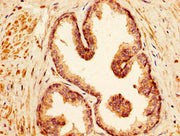 IHC image of CSB-PA745337HA01HU diluted at 1:500 and staining in paraffin-embedded human prostate cancer performed on a Leica BondTM system. After dewaxing and hydration, antigen retrieval was mediated by high pressure in a citrate buffer (pH 6.0)...
