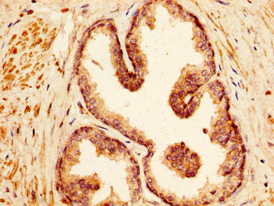 IHC image of CSB-PA745337HA01HU diluted at 1:500 and staining in paraffin-embedded human prostate cancer performed on a Leica BondTM system. After dewaxing and hydration, antigen retrieval was mediated by high pressure in a citrate buffer (pH 6.0)...