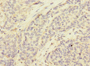 Immunohistochemistry of paraffin-embedded human ovarian cancer using CSB-PA745871ESR2HU at dilution of 1:100