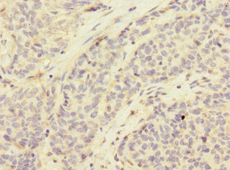Immunohistochemistry of paraffin-embedded human ovarian cancer using CSB-PA745871ESR2HU at dilution of 1:100