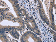 The image on the left is immunohistochemistry of paraffin-embedded Human colon cancer tissue using CSB-PA746124(KCNJ11 Antibody) at dilution 1/40, on the right is treated with fusion protein. (Original magnification: ×200)