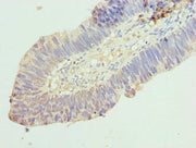 Immunohistochemistry of paraffin-embedded human ovarian cancer using CSB-PA747351LA01HU at dilution of 1:100