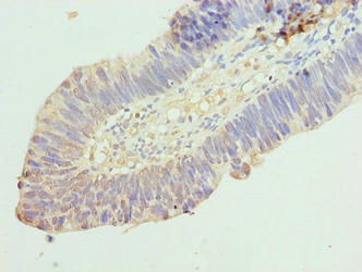 Immunohistochemistry of paraffin-embedded human ovarian cancer using CSB-PA747351LA01HU at dilution of 1:100