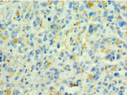 Immunohistochemistry of paraffin-embedded human melanoma using CSB-PA747568ESR2HU at dilution of 1:100