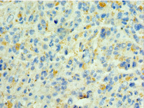 Immunohistochemistry of paraffin-embedded human melanoma using CSB-PA747568ESR2HU at dilution of 1:100