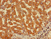 Immunohistochemistry of paraffin-embedded human liver cancer using CSB-PA747625LA01HU at dilution of 1:100