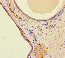 Immunohistochemistry of paraffin-embedded human prostate cancer using CSB-PA747798LA01HU at dilution of 1:100