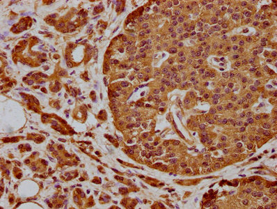 IHC image of CSB-PA747816LA01HU diluted at 1:300 and staining in paraffin-embedded human colon cancer performed on a Leica BondTM system. After dewaxing and hydration, antigen retrieval was mediated by high pressure in a citrate buffer (pH 6.0). S...
