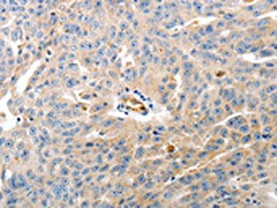 The image on the left is immunohistochemistry of paraffin-embedded Human ovarian cancer tissue using CSB-PA748239(CD93 Antibody) at dilution 1/60, on the right is treated with synthetic peptide. (Original magnification: ×200)