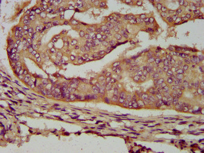 IHC image of CSB-PA748723LA01HU diluted at 1:200 and staining in paraffin-embedded human endometrial cancer performed on a Leica BondTM system. After dewaxing and hydration, antigen retrieval was mediated by high pressure in a citrate buffer (pH 6...