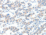The image on the left is immunohistochemistry of paraffin-embedded Human breast cancer tissue using CSB-PA748751(XBP1 Antibody) at dilution 1/70, on the right is treated with fusion protein. (Original magnification: ×200)