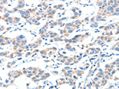 The image on the left is immunohistochemistry of paraffin-embedded Human breast cancer tissue using CSB-PA748751(XBP1 Antibody) at dilution 1/70, on the right is treated with fusion protein. (Original magnification: ×200)