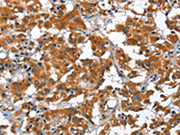 The image on the left is immunohistochemistry of paraffin-embedded Human thyroid cancer tissue using CSB-PA749878(COPB1 Antibody) at dilution 1/30, on the right is treated with fusion protein. (Original magnification: ×200)