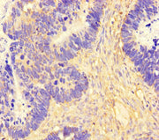 Immunohistochemistry of paraffin-embedded human ovarian cancer using CSB-PA750765LA01HU at dilution of 1:100