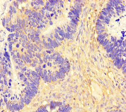 Immunohistochemistry of paraffin-embedded human ovarian cancer using CSB-PA750765LA01HU at dilution of 1:100