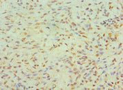 Immunohistochemistry of paraffin-embedded human breast cancer using CSB-PA750768ESR1HU at dilution of 1:100