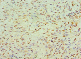 Immunohistochemistry of paraffin-embedded human breast cancer using CSB-PA750768ESR1HU at dilution of 1:100