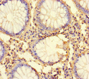 Immunohistochemistry of paraffin-embedded human colon cancer using CSB-PA750774HA01HU at dilution of 1:100