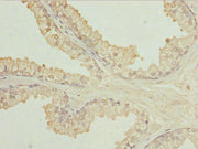 Immunohistochemistry of paraffin-embedded human prostate cancer using CSB-PA750879ESR2HU at dilution of 1:100