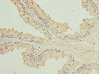 Immunohistochemistry of paraffin-embedded human prostate cancer using CSB-PA750879ESR2HU at dilution of 1:100